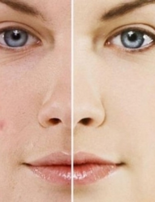 Điều trị mụn trứng cá