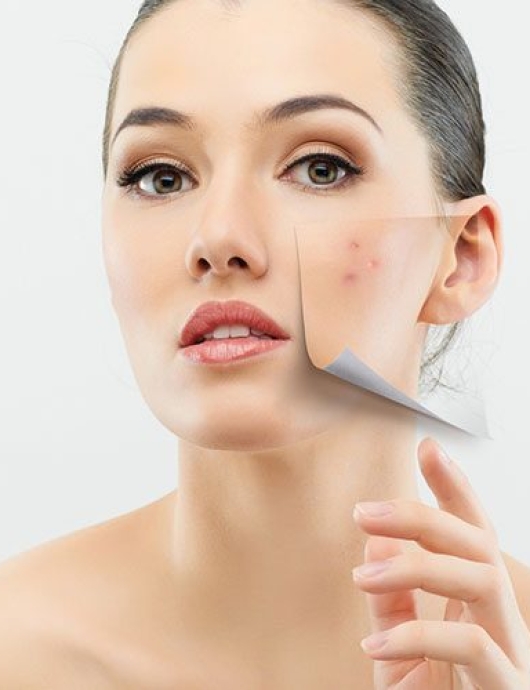 Điều trị da mụn