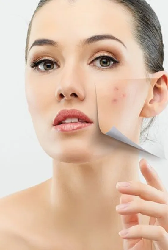 Điều trị da mụn